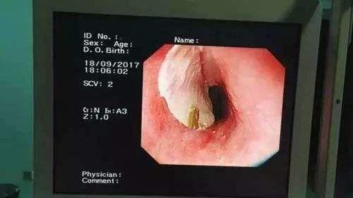 今日特码科普！男子遭4cm鱼刺卡喉,百科词条爱好